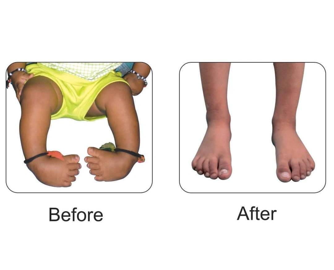 Clubfoot Program - Early Steps Toward a Better Future
